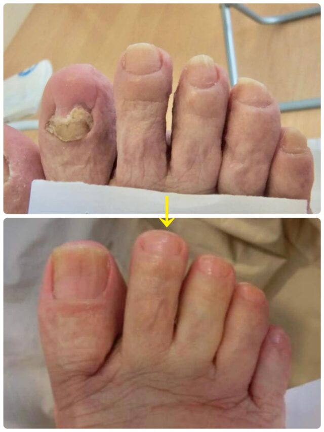 巻き爪や足爪を確認するフットケア