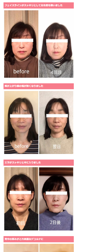 小顔矯正のビフォーアフター事例 3