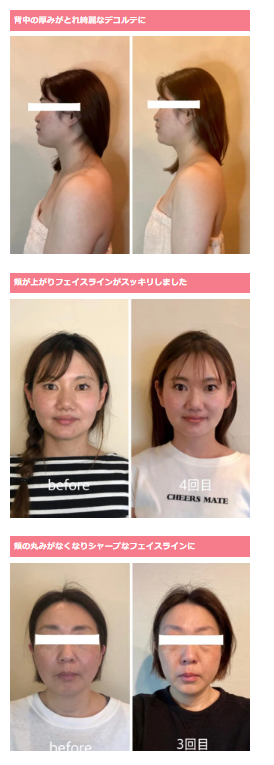 小顔矯正のビフォーアフター事例 4